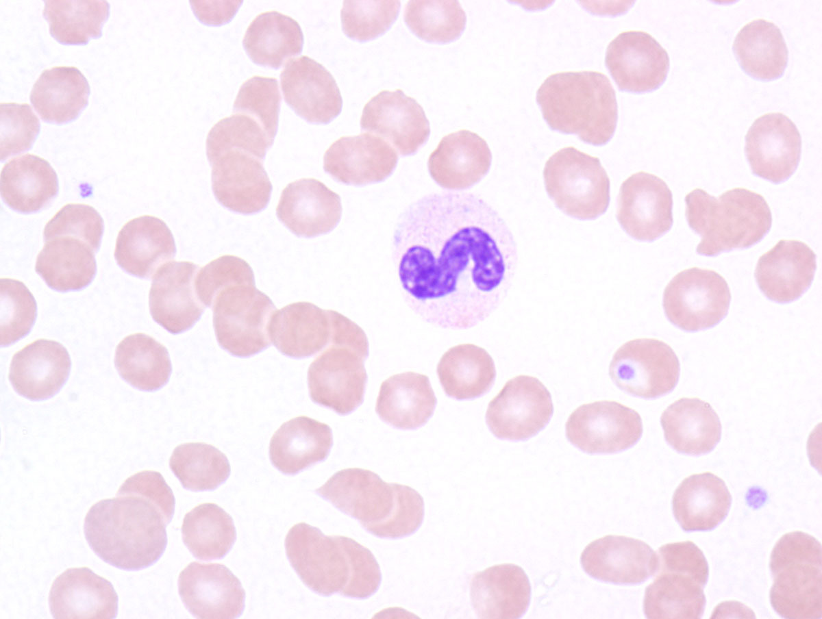 Peripheral blood with hypolobated neutrophils